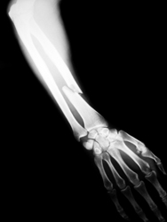 Broken Bones / Fractures