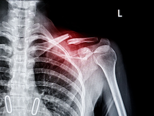 Clavicle Fracture - Xray