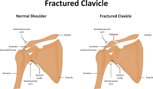 Types of Clavicle Fractures