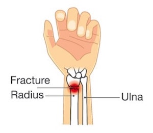 Distal radius fracture