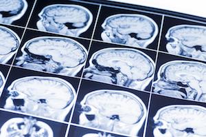 Brain MRI