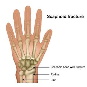 Scaphoid Fracture
