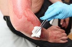 Burned arm