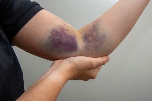 blunt force trauma injury
