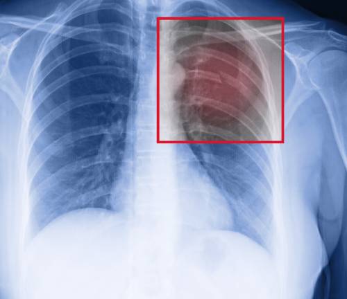 rib fracture