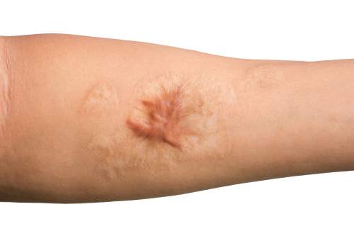 keloid scar