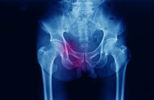 pelvic fracture
