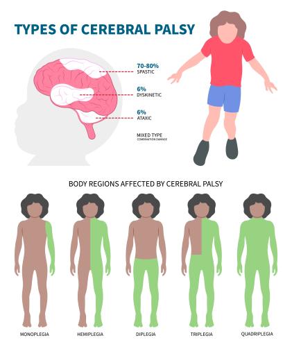 cerebral palsy