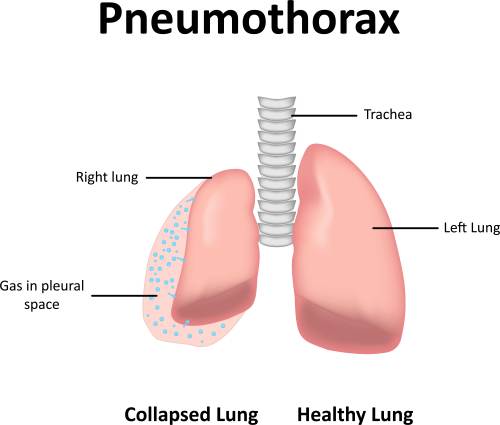 Illinois pneumothorax lawyers