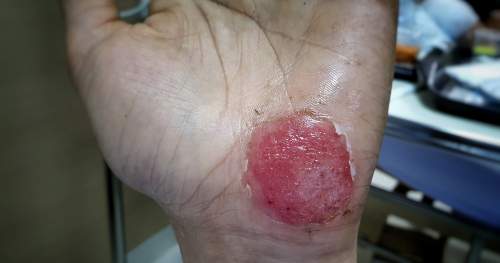 road rash injury lawyers